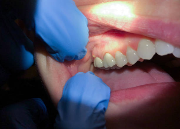 Best Emergency Dentist for Lost Fillings or Crowns in Campbellsport, WI